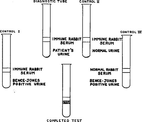 bence jones protein test results